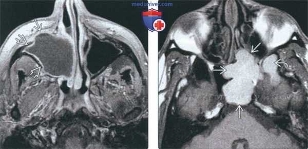 КТ, МРТ при мукоцеле носа и околоносовых пазух