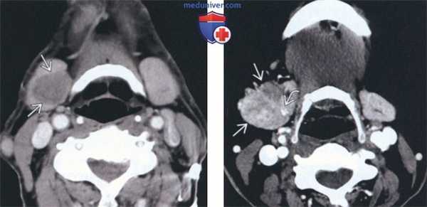 Лучевая диагностика доброкачественной смешанной опухоли поднижнечелюстной железы