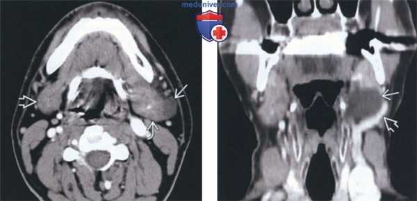 Лучевая диагностика мукоцеле поднижнечелюстной железы