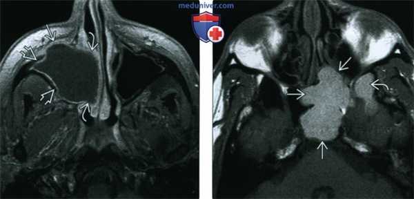 КТ, МРТ при мукоцеле пазух носа