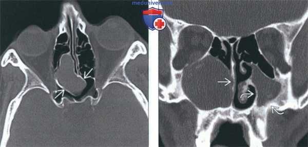 КТ, МРТ при мукоцеле носа и околоносовых пазух