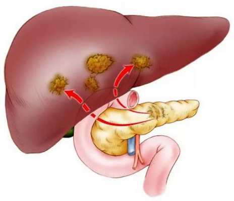 Рак поджелудочной железы с метастазами