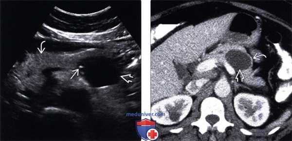 УЗИ, КТ при муцинозной кистозной опухоли поджелудочной железы
