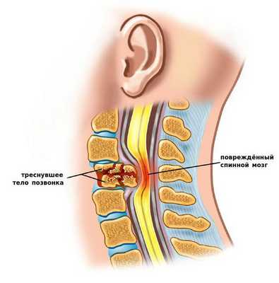Разрушение позвонка