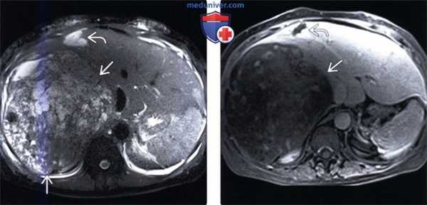 Лучевая диагностика недифференцированной саркомы печени