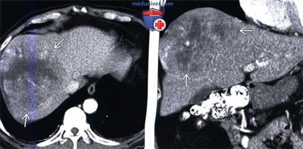 Лучевая диагностика недифференцированной саркомы печени
