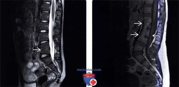 МРТ при нарушении сегментации позвонков