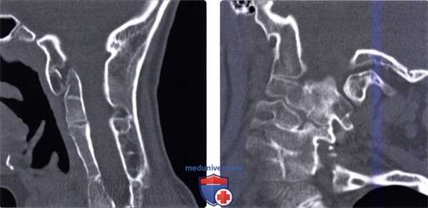 КТ при нарушении сегментации позвонков