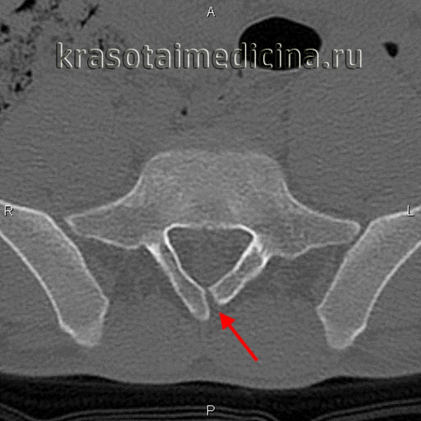 КТ поясничного отдела позвоночника. Отсутствие полного слияния дуги L5 (Spina bifida)