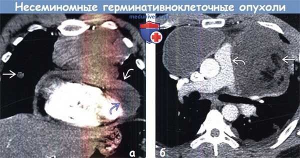 Несеминомная герминативноклеточная опухоль средостения на КТ