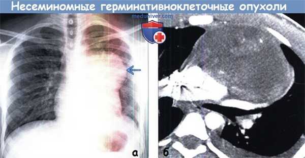 Несеминомная герминативноклеточная опухоль средостения на рентгенограмме, КТ