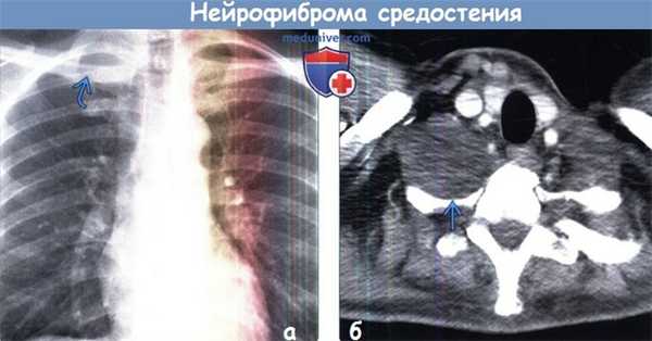 Нейрофиброма средостения на рентгенограмме, КТ