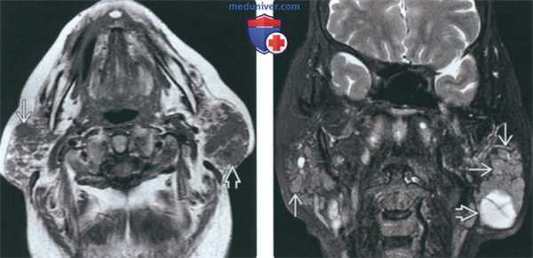 КТ, МРТ при неходжкинской лимфоме околоушной железы