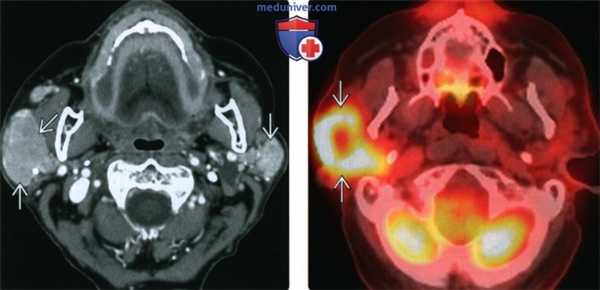 КТ, МРТ, УЗИ при неходжкинской лимфоме околоушной железы