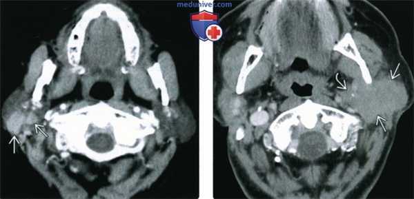 КТ, МРТ, УЗИ при неходжкинской лимфоме околоушной железы
