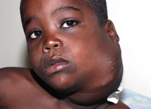 Увеличение шейных лимфоузлов при лимфогранулематозе