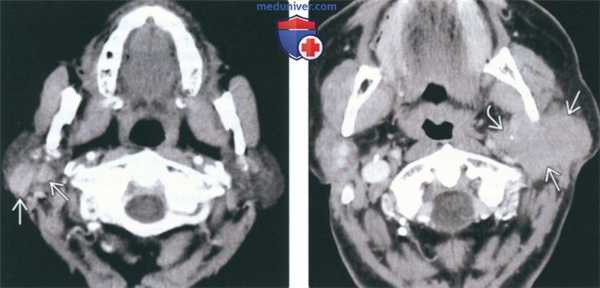 КТ, МРТ при неходжкинской лимфоме околоушной железы