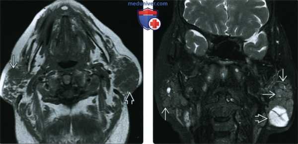 КТ, МРТ, УЗИ при неходжкинской лимфоме околоушной железы