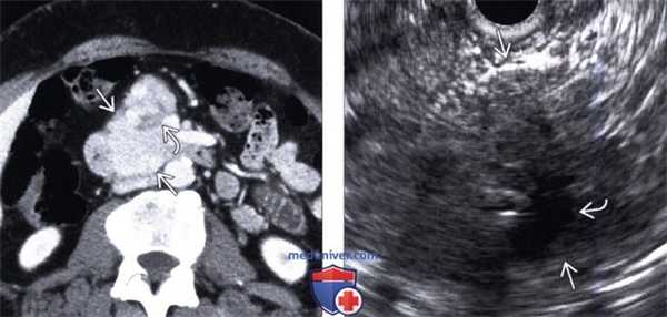 УЗИ при нейроэндокринной опухоли поджелудочной железы