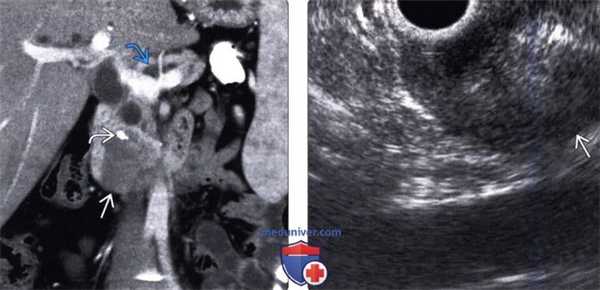 УЗИ при нейроэндокринной опухоли поджелудочной железы