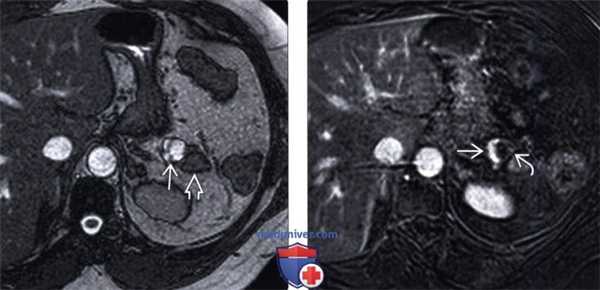 УЗИ при нейроэндокринной опухоли поджелудочной железы