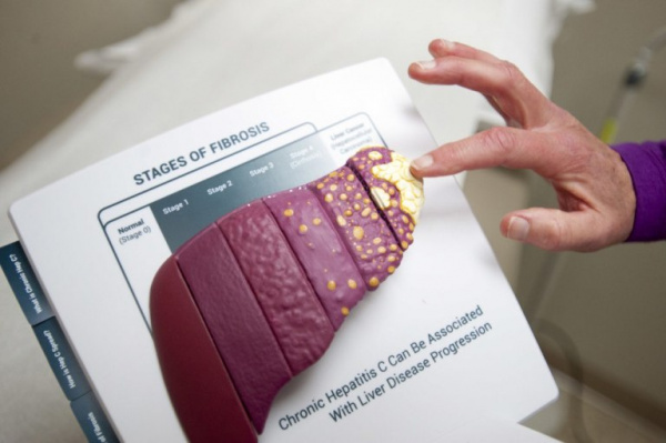 Фиброз печени