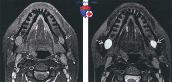 Рентгенограмма, КТ, МРТ при опухоли оболочки нерва челюсти
