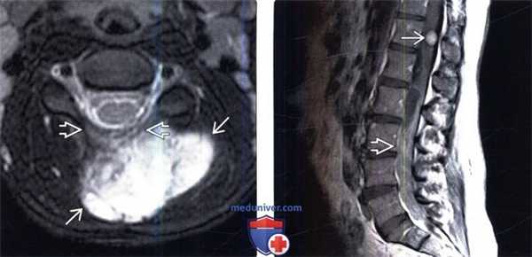 МРТ при злокачественой опухоли оболочки периферического нерва (ЗООПН)