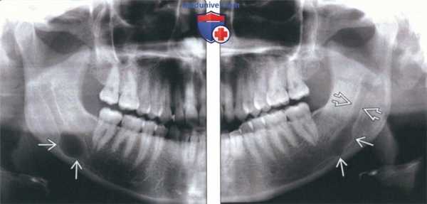 Рентгенограмма, КТ, МРТ при опухоли оболочки нерва челюсти
