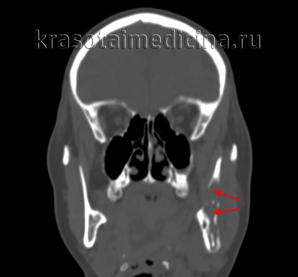 Опухоли челюстей