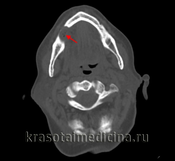 Рак верхней челюсти 