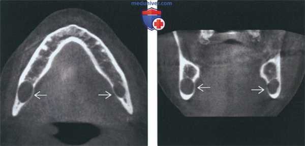 Рентгенограмма, КТ, МРТ при опухоли оболочки нерва челюсти
