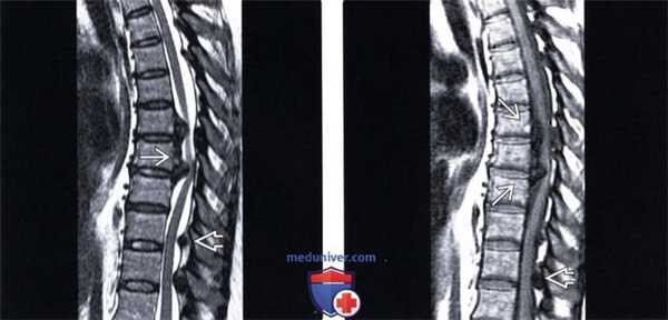 МРТ оссификации задней продольной связки (ОЗПС)