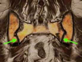 крестцово-подвздошные