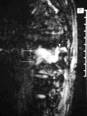 псевдоартроз - МРТ.jpg