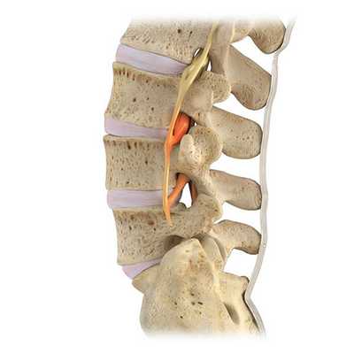 Сдавление L3 спинального нерва в межпозвонковом отверстии при экстрафораминальном стенозе (сужении просвета).