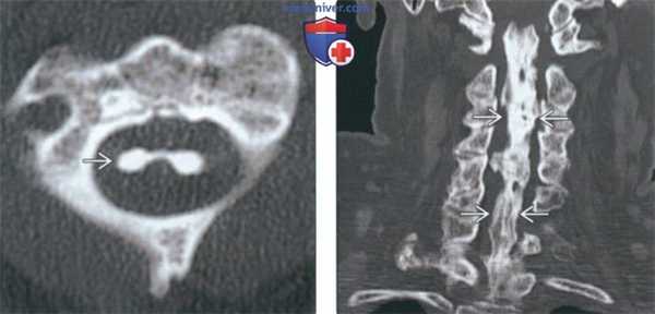 Рентгенограмма, КТ, МРТ при оссификации задней продольной связки