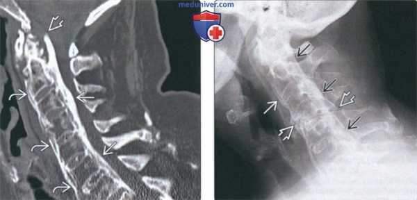 Рентгенограмма, КТ, МРТ при оссификации задней продольной связки