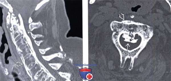 МРТ оссификации задней продольной связки (ОЗПС)