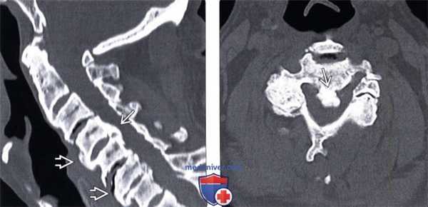 МРТ оссификации задней продольной связки (ОЗПС)