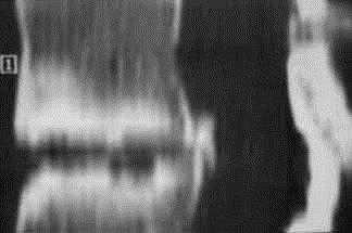 псевдоартроз - КТ.jpg