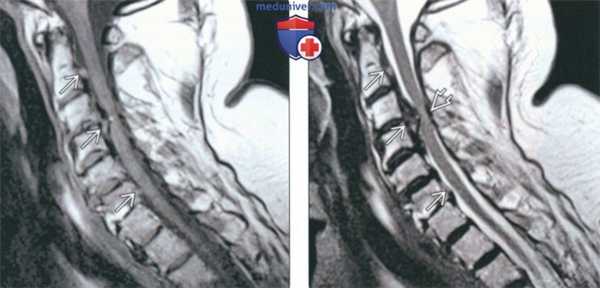 Рентгенограмма, КТ, МРТ при оссификации задней продольной связки