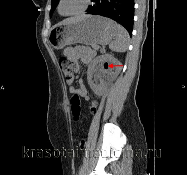 Пиелонефрит
