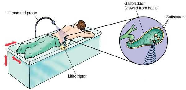 Ультразвуковая литотрипсия