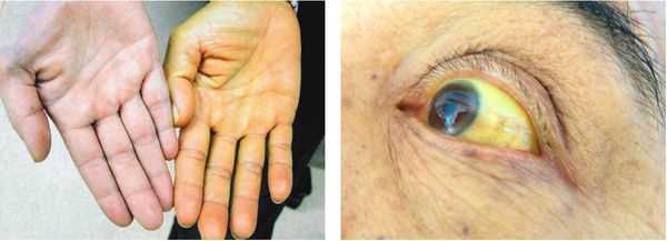 Симптомы обострения хронического холецистита