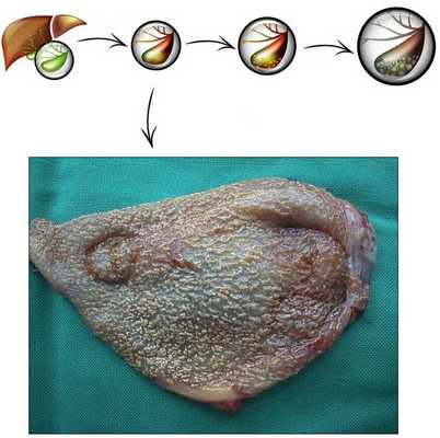 Этапы развития хронического холецистита