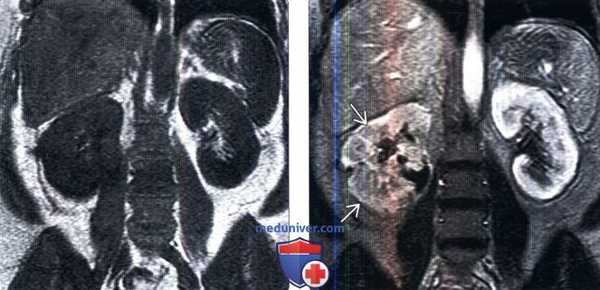 КТ, МРТ при остром пиелонефрите