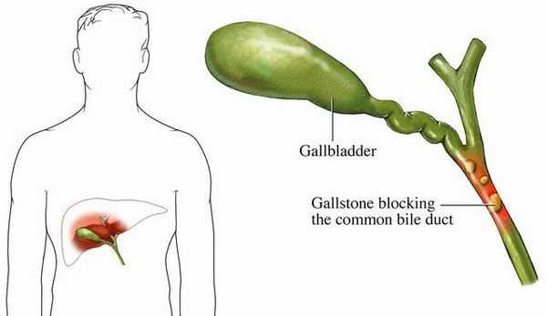 Холедохолитиаз