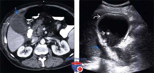 КТ, УЗИ при остром бескаменном холецистите