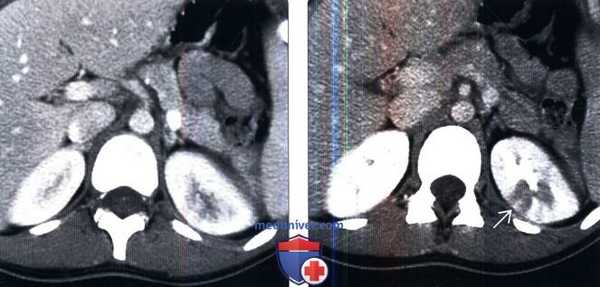КТ, МРТ при остром пиелонефрите